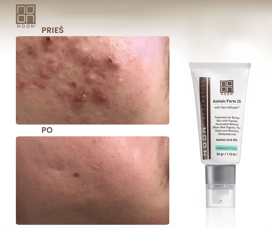 Noon Azelaic Forte 25 - DermaOnline by Provederma