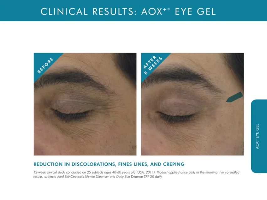 Antes y después Aox eye gel skinceuticals